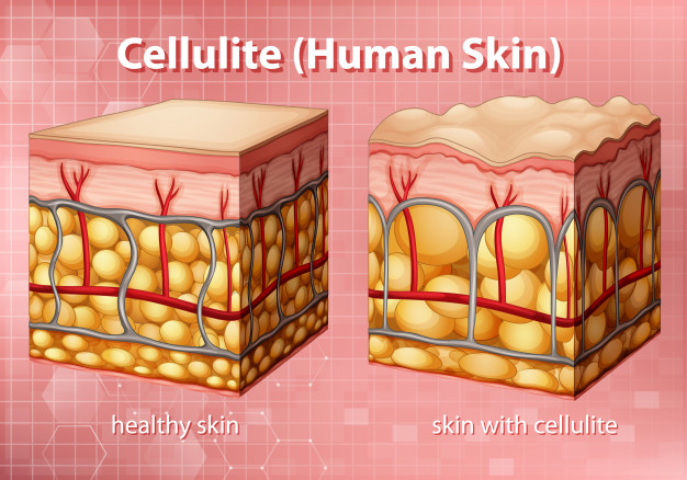 ما هو السيلوليت Cellulite وما أعراضه