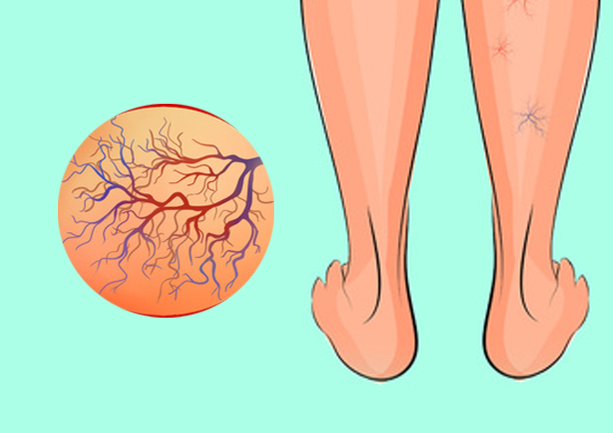 طرق علاج دوالي الساقين