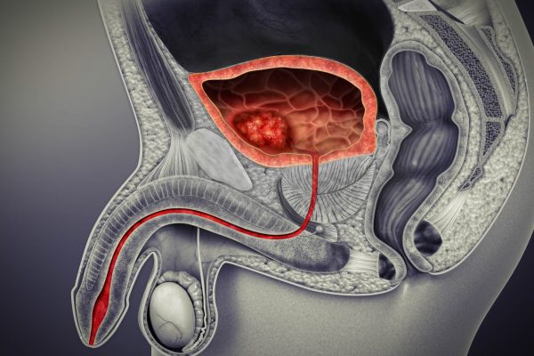 علامات واعراض سرطان البروستاتا
