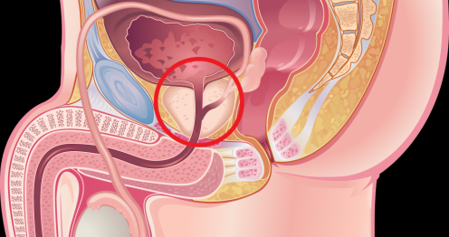 علامات واعراض سرطان البروستاتا