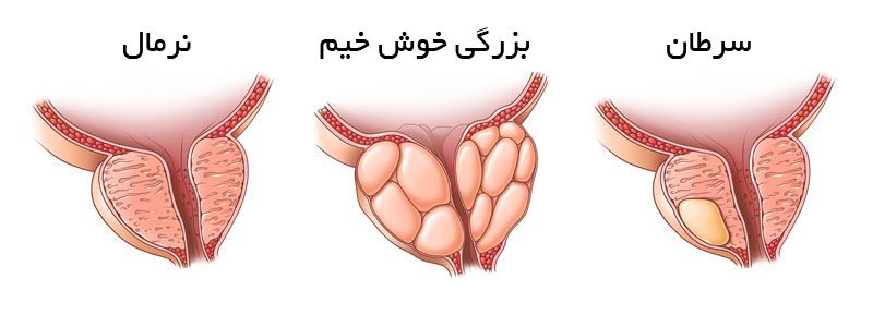 العلاقة بين انقطاع النفس الانسدادي النومي والتبول الليلي المتكرر