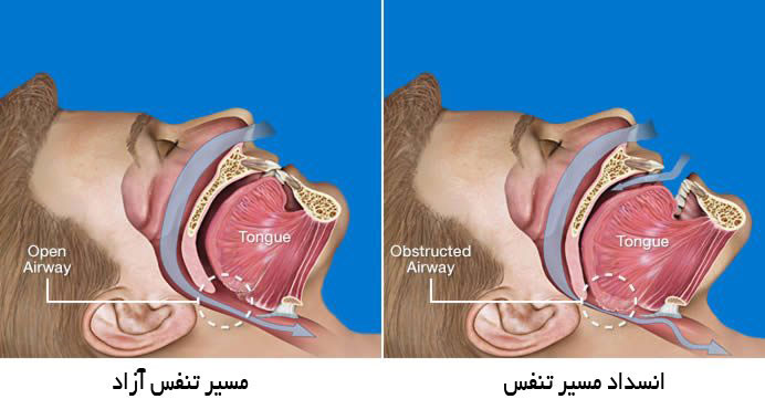 أسباب كثرة التبول الليلي