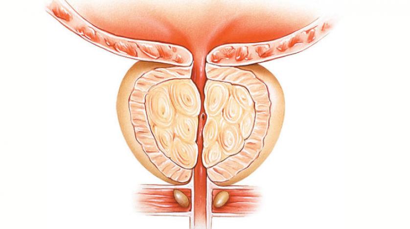 أنواع سرطان البروستاتا 