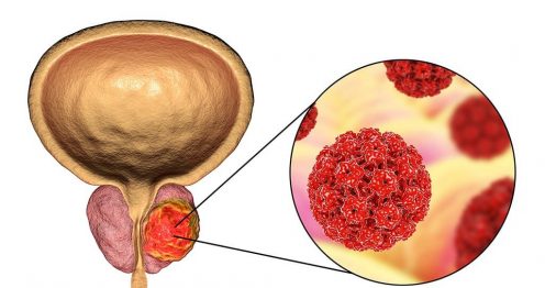 سرطان البروستاتا