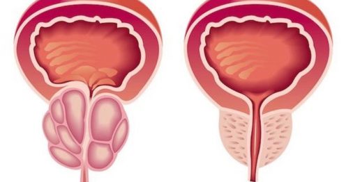 علاج التهاب البروستاتا