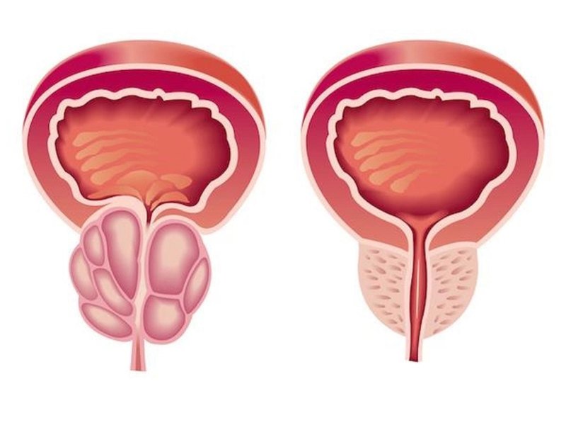 علاج التهاب البروستاتا