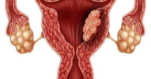 ما الذي يسبب الأورام الليفية الرحمية؟ وطرق علاجه