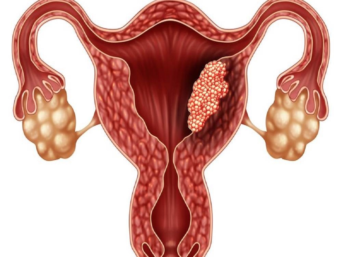 ما الذي يسبب الأورام الليفية الرحمية؟ وطرق علاجه